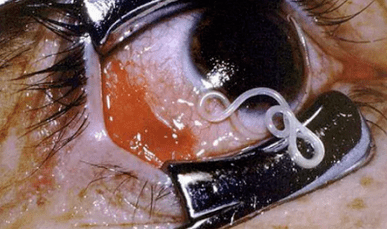 Τύποι παρασίτων στο ανθρώπινο σώμα